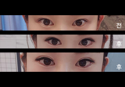 [目] サブリ9999 - 下眼瞼下制術、目尻切開