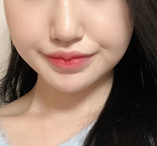 [皮膚] ジジジジジジ - シュリンク、輪郭ボトックス