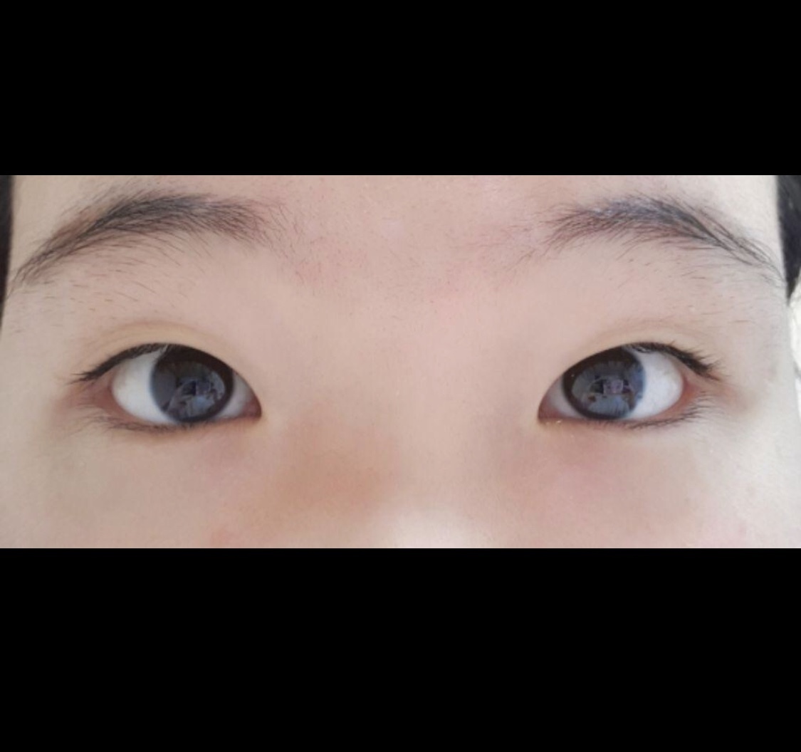 [目] ソ・ユユン - 埋没法、目頭切開