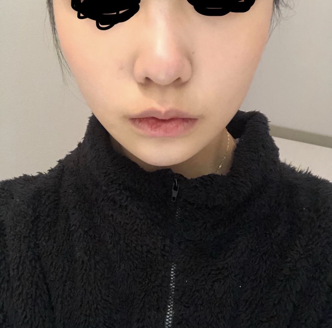 [鼻] mm9 - 小鼻縮小