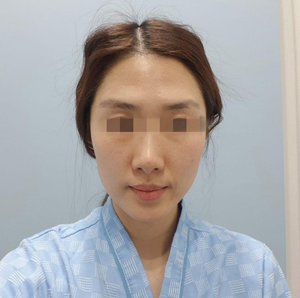 [プチ]ビンビンさんの家 - フルフェイス脂肪移植