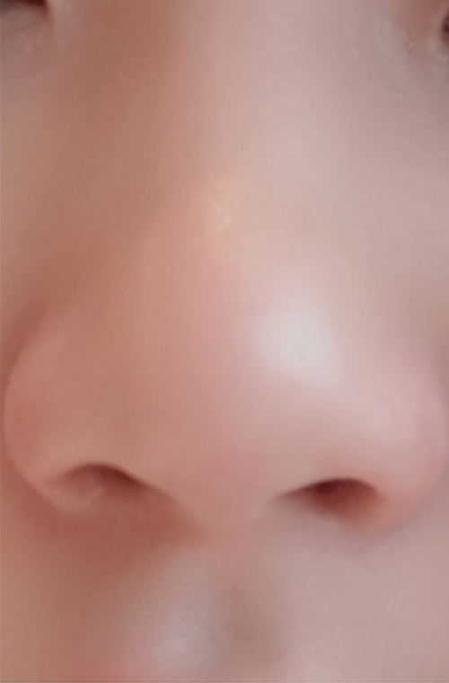 [プチ] 7時11分 - 鼻の輪郭注射