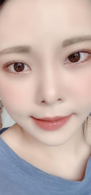 [目] songi1938 - 目尻切開、タレ目形成