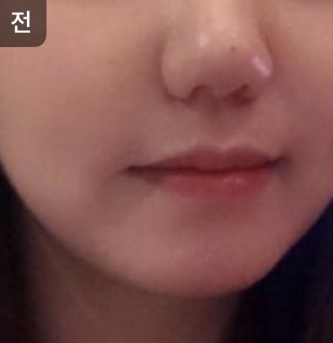 [皮膚] oy1004 - リフティング、水光注射