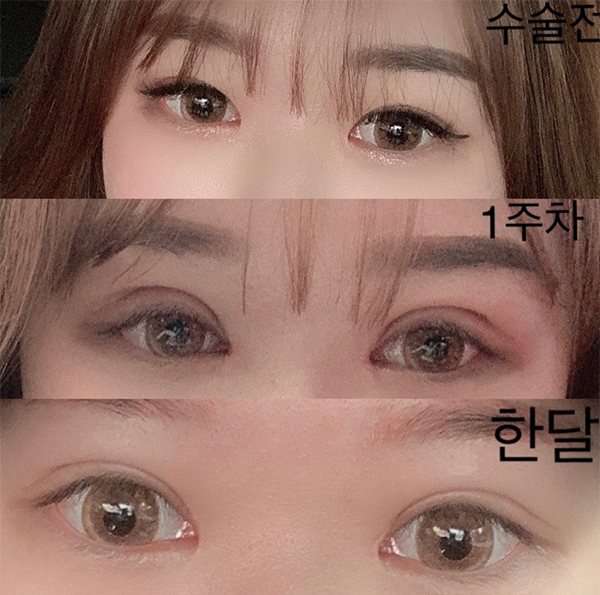 [目] ロシオン - 目頭切開（上眼瞼切開）、眼瞼下垂手術、再手術