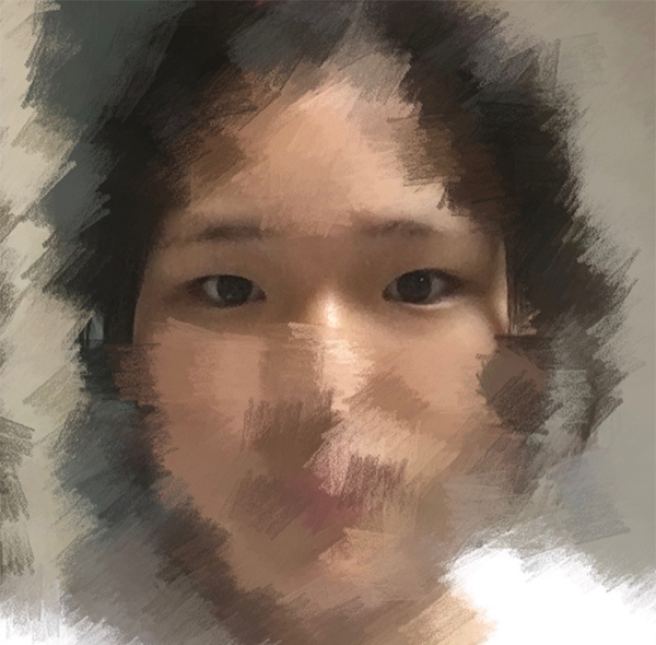 [目] チョン・イェスル - 目頭切開、眼瞼下垂手術