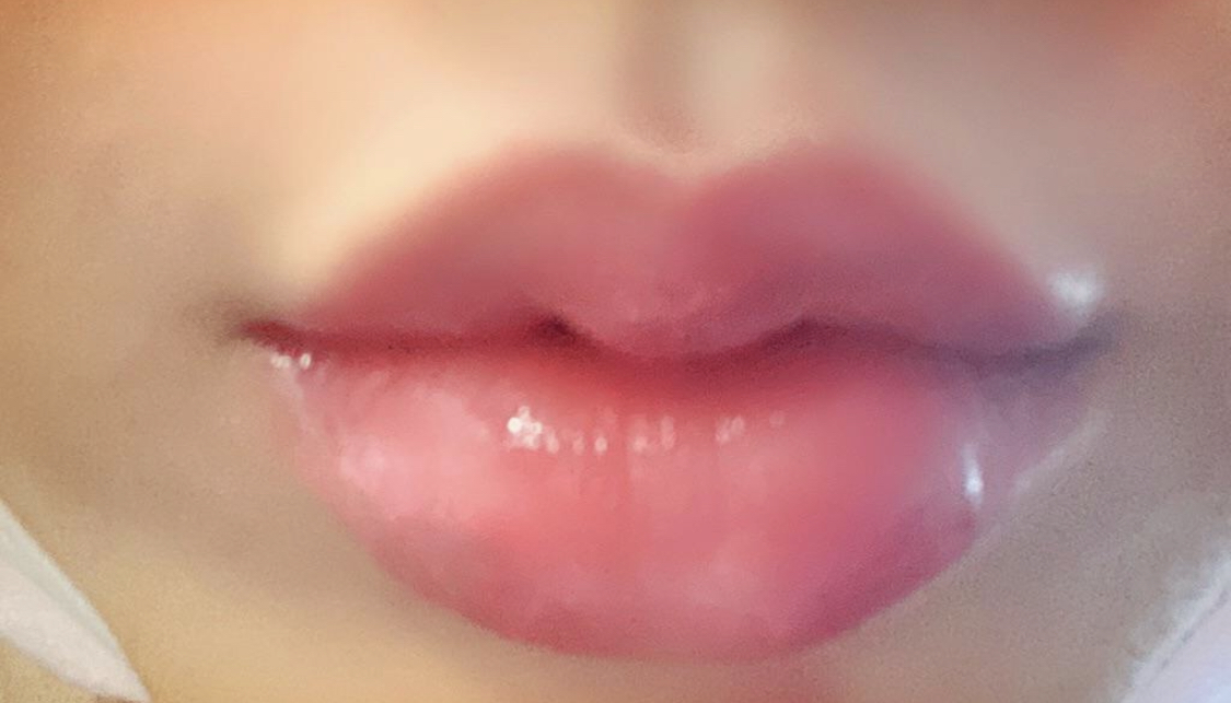 【プチ】チョンドゥン2 - 唇フィラー