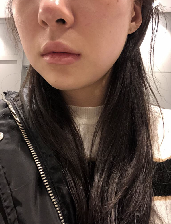 [皮膚] ハナハヌン - シュリンク