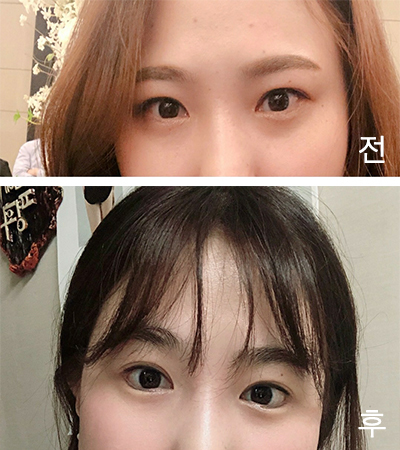 [目] キュジナ - 目尻切開、タレ目形成