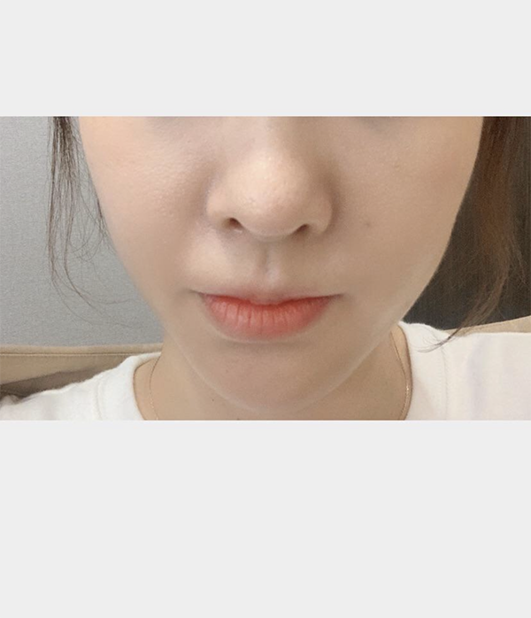 [プチ] 55針 - 糸リフティング