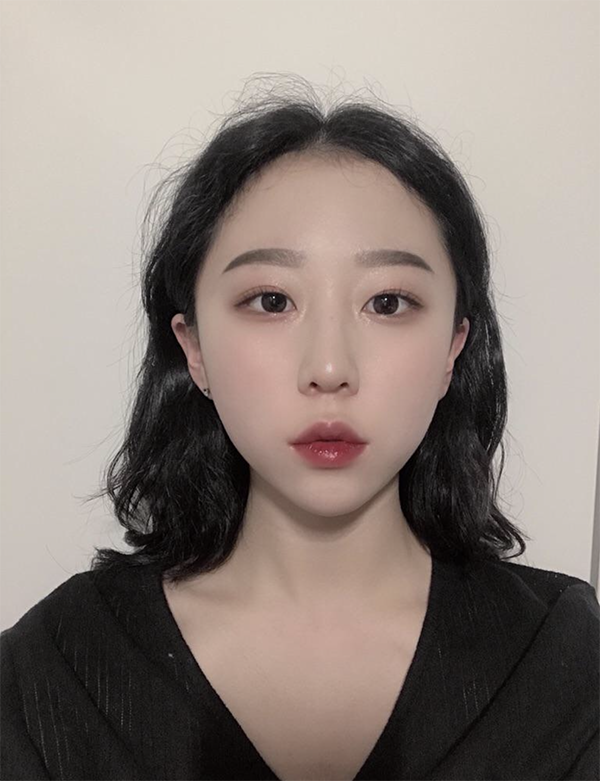 [プチ] 夜のマンゴースナ - ボトックス、フィラー