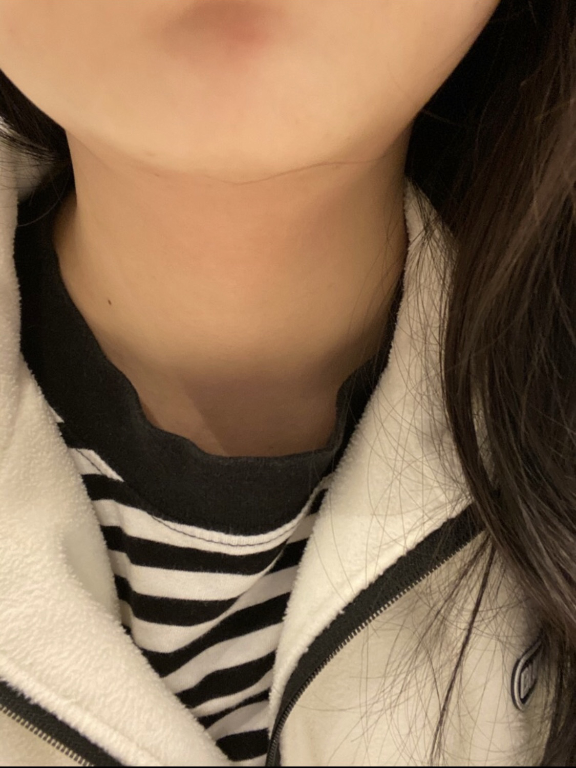 [プチ]顎ボトックス - シュリンクリフティング