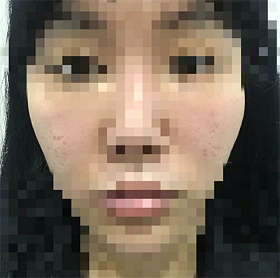 [쁘띠] yuyya - 輪郭注射