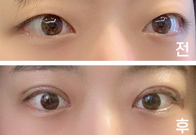 [目] 屋根s2 - 目頭切開、眼瞼下垂手術