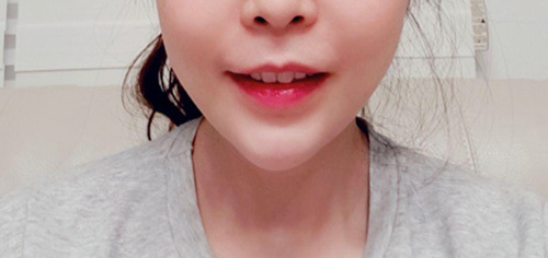 [皮膚] gus0311 - フィラー、リフティング