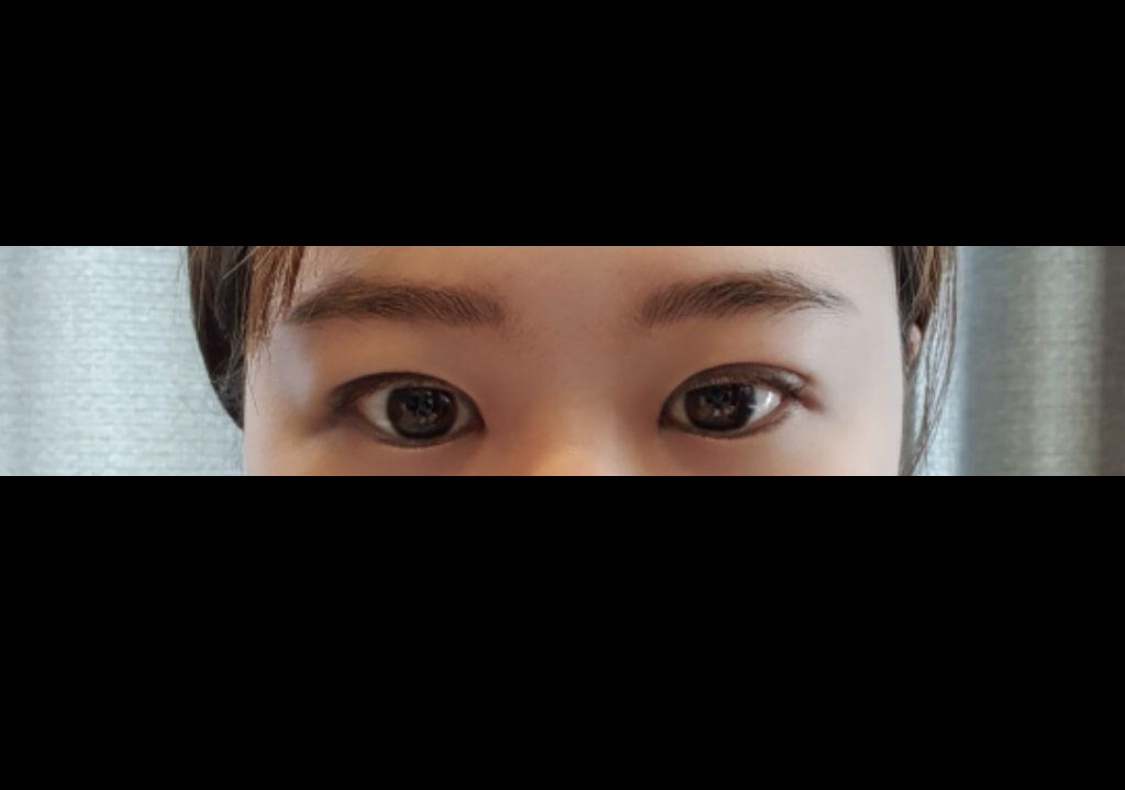 [目] じわるん - 垂れ目形成、目尻切開