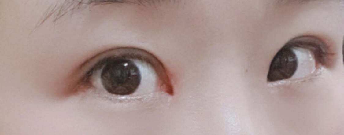 [目] ピングチン - 目つき矯正、切開