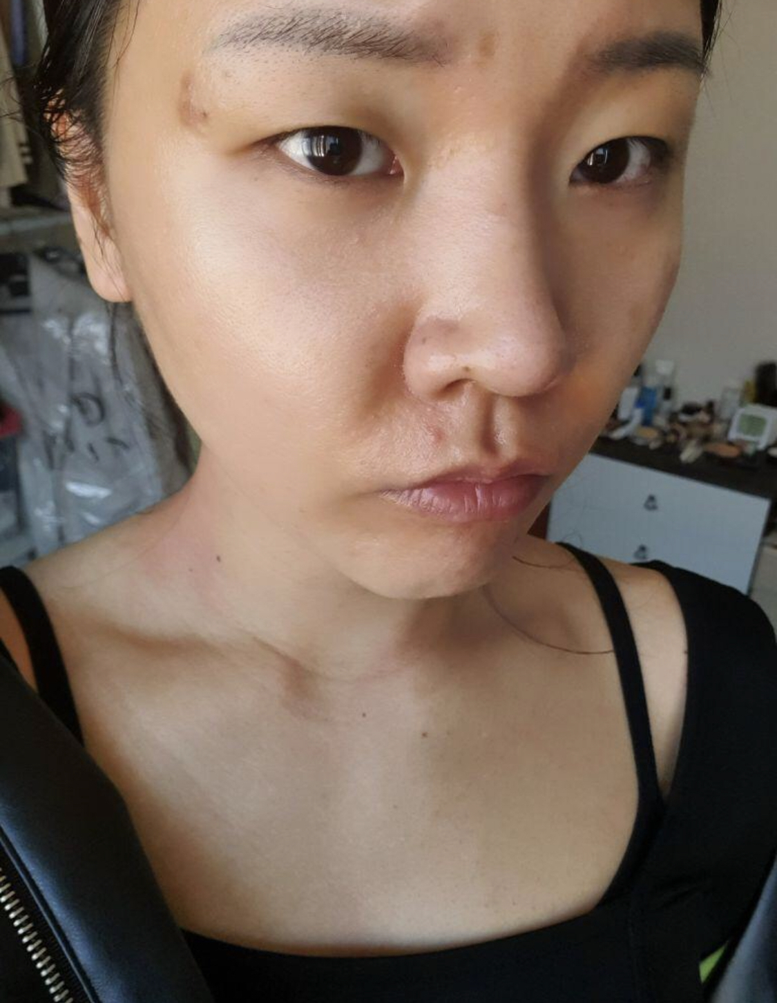 [目] ビンナビンナ - 切開、切開術