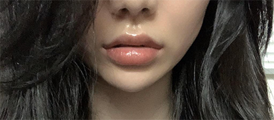 [プチ] 頬骨イン - フィラー、リフティング