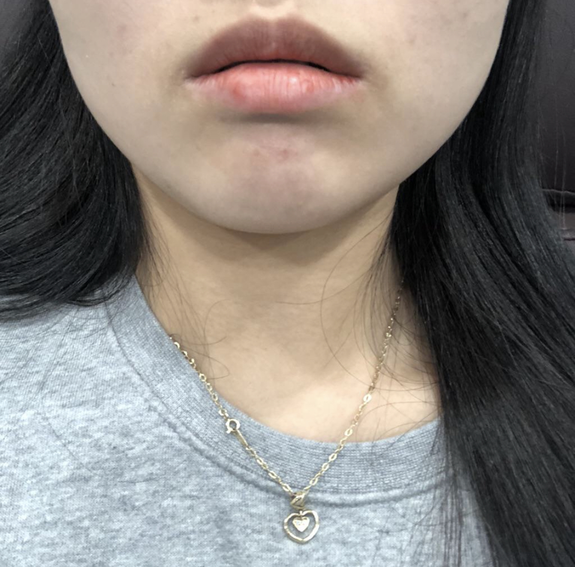 [쁘띠] soosooh - ボトックス、フィラー