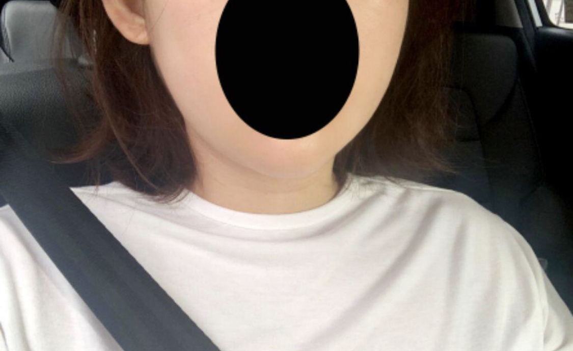 [アンチエイジング] プレイン817 - 顔の脂肪吸引