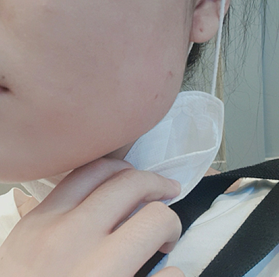 [プチ] seoul - 顎ボトックス