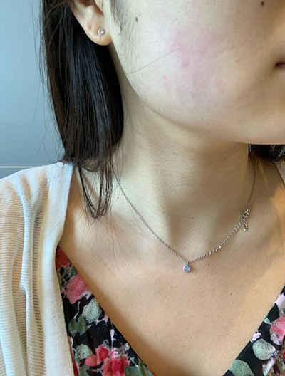 [皮膚] カフェオレ - ウルセラリフト