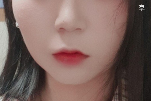 [アンチエイジング] alss12 - 顔の脂肪吸引