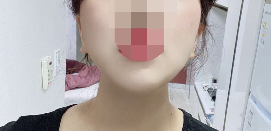 [脂肪吸引] ビマスクへ - 顔の脂肪吸引