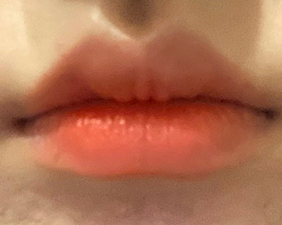 [쁘띠] ラプンツェル@ - 唇フィラー