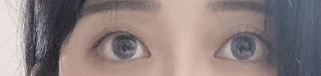 [目] Hitwo - 目つき矯正、埋没法