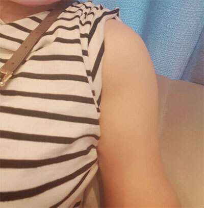 [脂肪吸引] ラリオレロ - 脂肪吸引