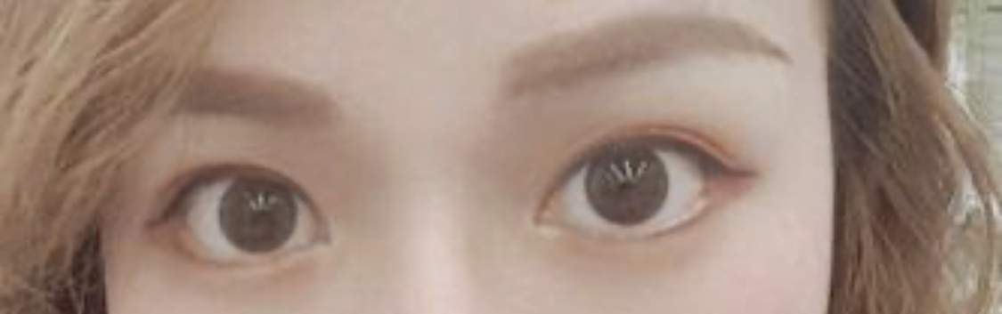 [目] 思い通りに - 目尻切開、グラマラスライン形成