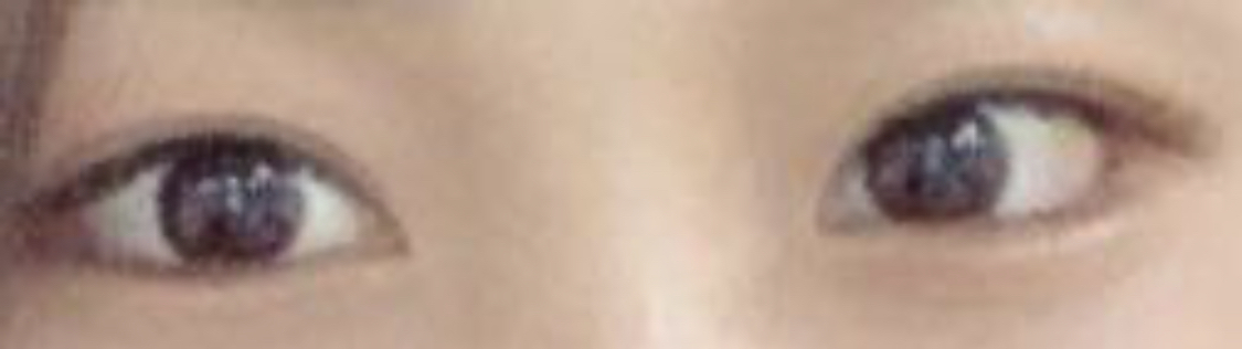 [目] さわやかな朝 - 涙袋形成、目尻切開