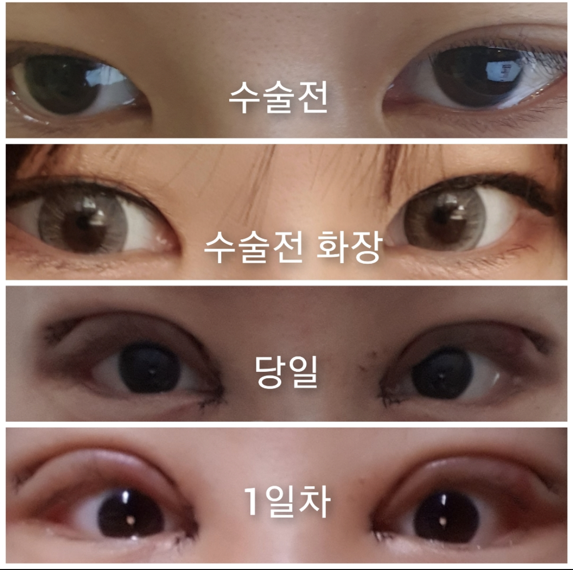 [目] コギヨン - 二重まぶた、目頭切開、目尻切開