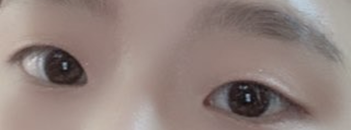 [目] イ・ス - 埋没法、目頭切開