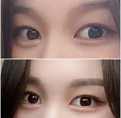 [目] ヨンドゥドゥ - 二重、切開