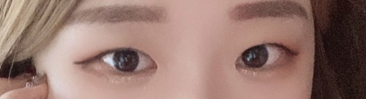 [目] Lulu - 目の再手術