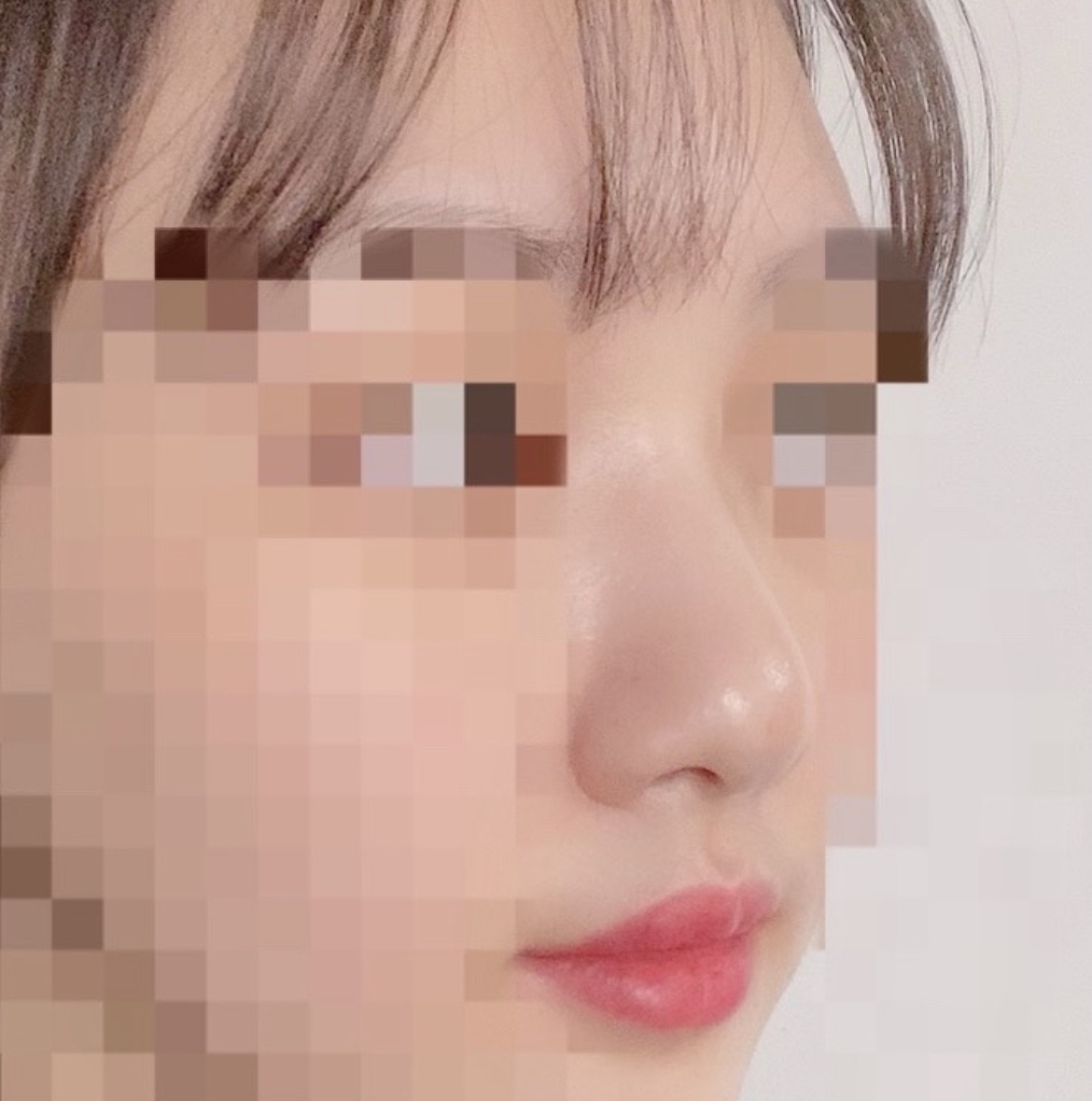 [鼻] ロンダランサ - 鼻整形