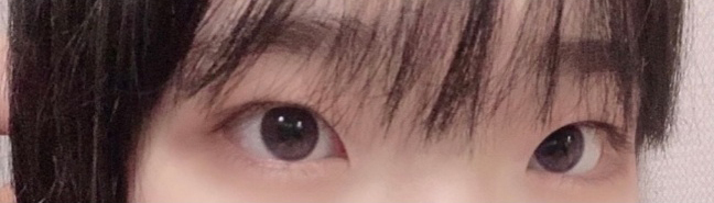 [目] クロミs2 - 二重(切開)、目頭切開