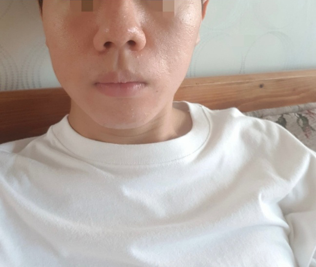 [鼻] 小鼻縮小 - 鼻