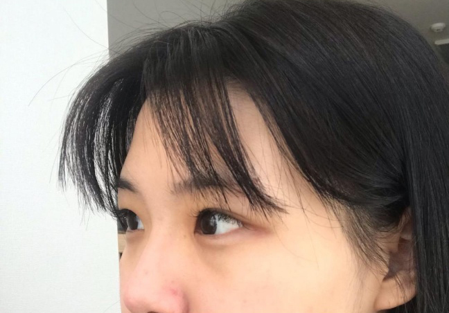 [目]ウンアンウン - 二重(自然癒着)、目頭切開