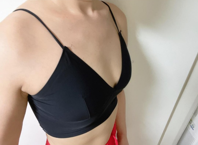 [豊胸] Barbi33 - 豊胸（プロテーゼ）