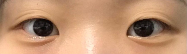 [目] イチゴをよこせ - 目頭切開、目つき矯正