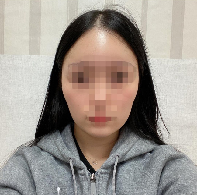 [輪郭手術] レモン55 - エラ削り、顎先縮小