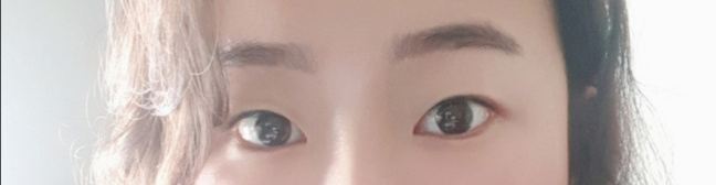 [目] ラビラビオン - 二重手術（切開）