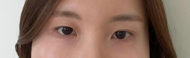 [目] wyn - 目頭切開、眼瞼下垂手術