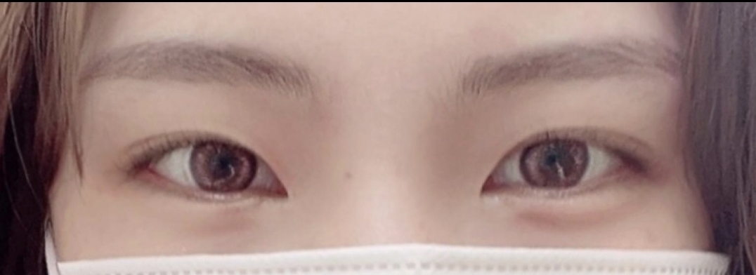 [目] itxufx - 目頭切開、目尻切開