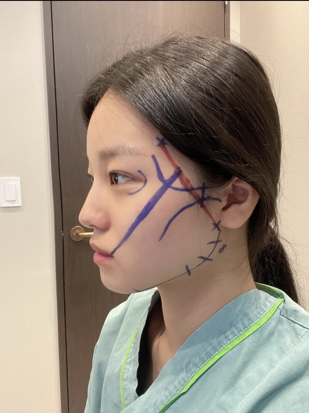 [輪郭手術] 光州姫姫 - 頬骨、顎先、エラ