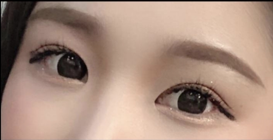 [目] sidhd22 - 目尻切開、グラマラスライン形成